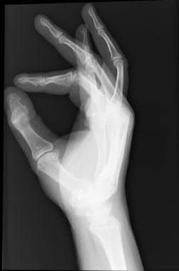 Congenital Onychodystrophy of the Index Fingers Workup: Approach ...