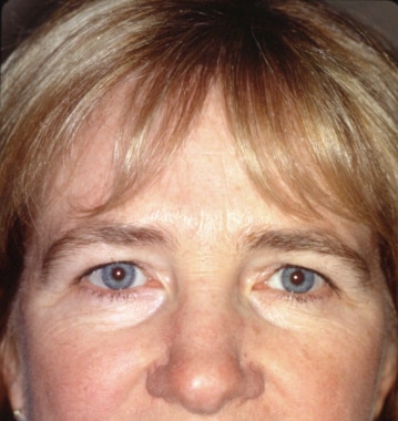 Front view of the nose with no distortion of the s