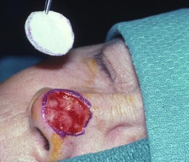 In split-thickness skin grafting, a template of th