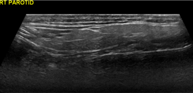 Sagittal image of the right parotid gland showing 
