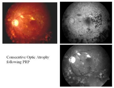 Consecutive optic atrophy following panretinal pho