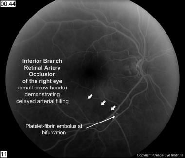 Fluorescein angiogram of right eye with inferior b
