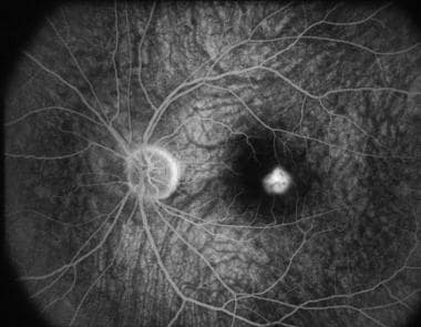 Fluorescein angiography in the early recirculation