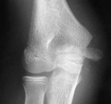 Distal Humerus Fracture - Carolina Regional Orthopedics