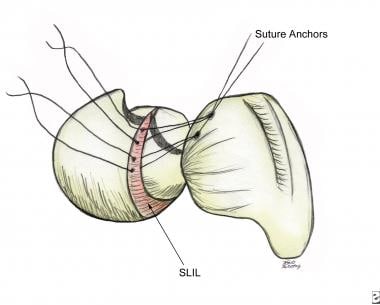 Drawing demonstrating suture anchor placement for 