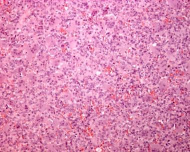 Photomicrograph of giant cell tumor reveals typica