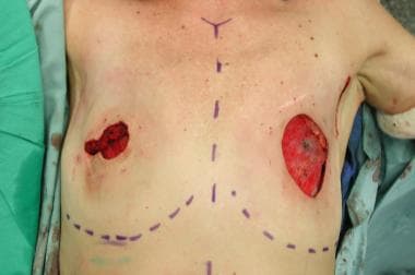 Expander-implant breast reconstruction. Intraopera