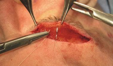 Direct brow lift. Placement of deep dermal sutures