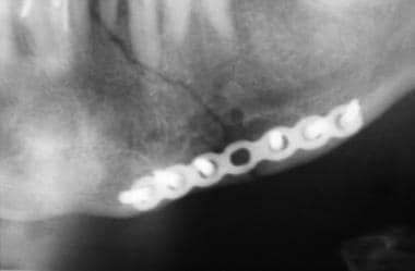 Mandibular fracture. Postoperative radiograph demo