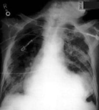 Myocardial Rupture. Chest radiograph in the poster