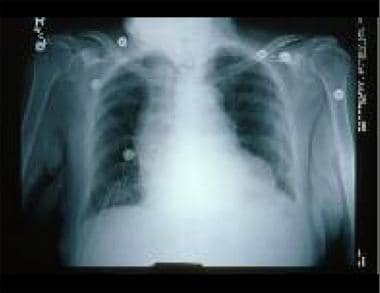 Heart Failure. This chest radiograph shows an enla