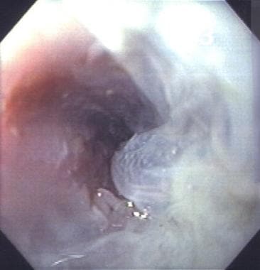 Blistering of the esophageal mucosal layer after c
