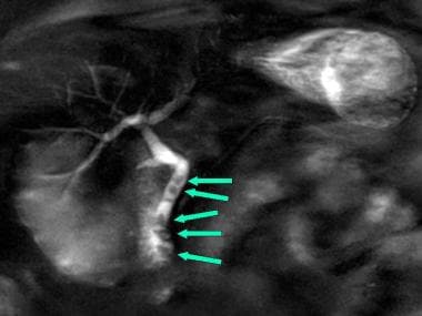 Magnetic resonance cholangiopancreatography (MRCP)