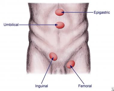 Anatomic locations for various hernias. 