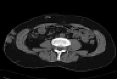 Abdominal CT scan shows absent inferior vena cava 
