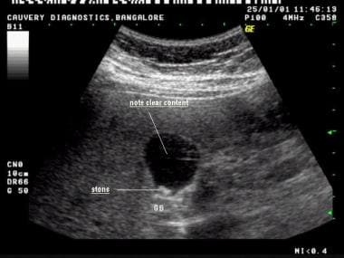 Transverse scan shows stone in neck of gallbladder