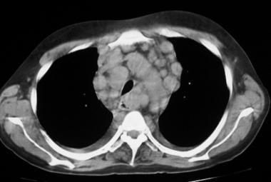 Nonenhanced CT scan through the mediastinum shows 