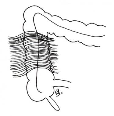 Jackson veil over ascending colon contains numerou