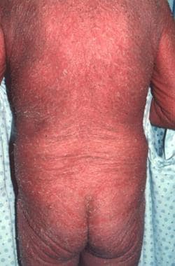 Erythroderma of Sézary syndrome. 