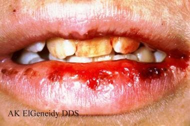 herpes 2 in the mouth