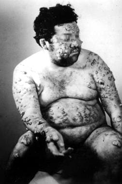 Diffuse (disseminated) cutaneous leishmaniasis. Co