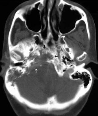 CT imaging demonstrates the extent of bony destruc