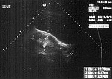 Transvaginal ultrasonography demonstrating an enla