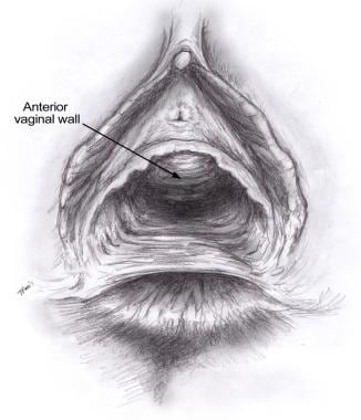 An attenuated perineal body results from trauma to