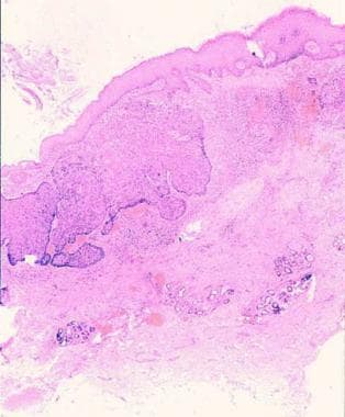 morpheaform basal cell carcinoma histology