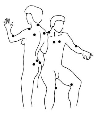 Tender points in fibromyalgia. 