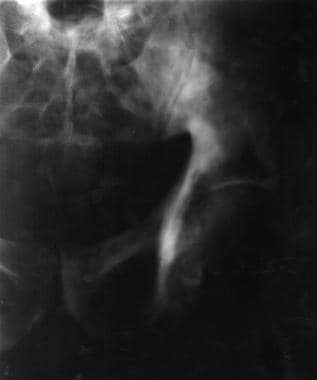 Radiograph showing a 44-year-old African American 