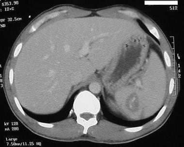 Intra-parenchymal blush observed on helical CT sca