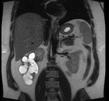 T2-weighted MRI, coronal image, displaying a right