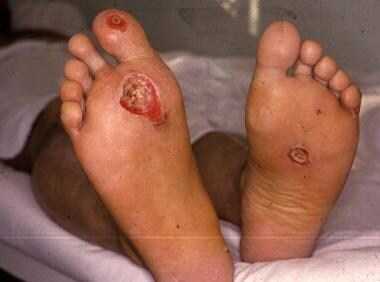 Grounded sites of low-voltage injury on the feet. 