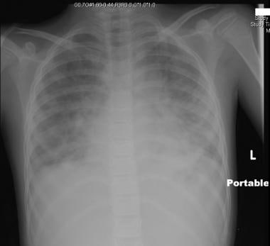 Eight-year-old girl with pneumonia and impending r