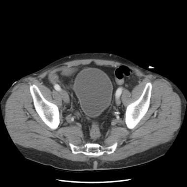 Normal bladder on CT scan. 