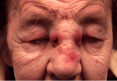 Nasal sinus clearance cancer