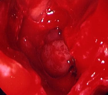 Resolved posterior epistaxis after endoscopic caut