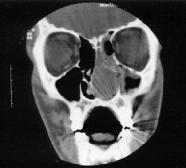 Coronal CT scan of the lesion filling the left nas