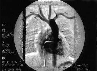 This right ventricular angiogram shows a patient w