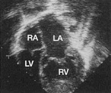 Surgical Approach to Corrected Transposition of th