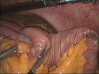 Laparoscopic view of a jejuno-jejunal intussuscept