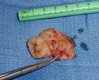 Resected Meckel diverticulum demonstrating ulcer. 