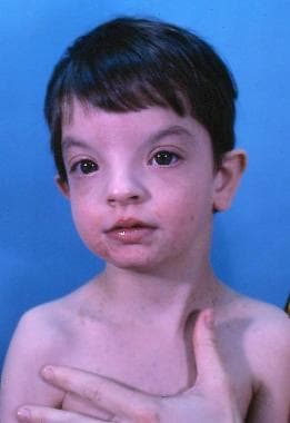A child with Wolf-Hirschhorn syndrome. Note the ch
