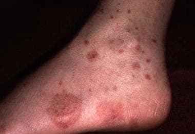 Hemorrhagic macules, papules, and patches on the a