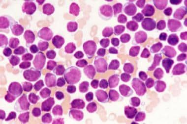 acute lymphoblastic leukemia bone marrow biopsy