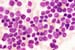 Acute Lymphoblastic Leukemia (ALL) Staging: Classification for Acute ...