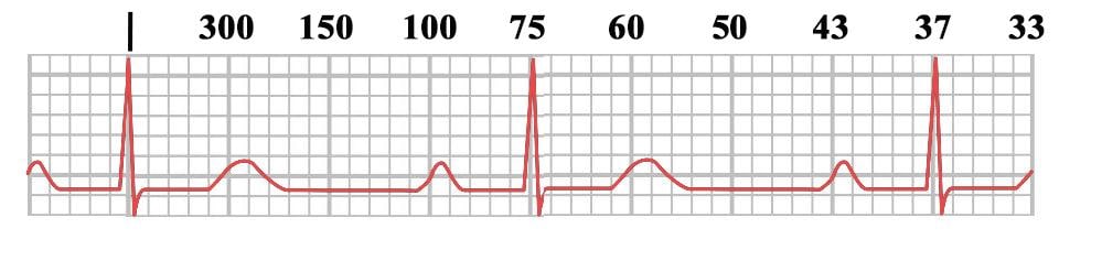 How To Read An Ecg