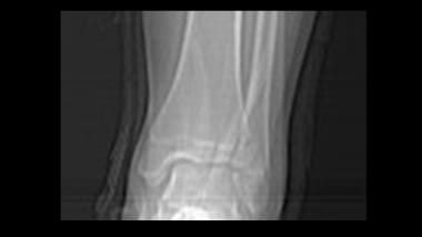 Growth plate (physeal) fractures. Tillaux fracture
