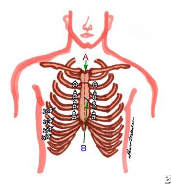 Anterolateral intercostal nerve block technique. S